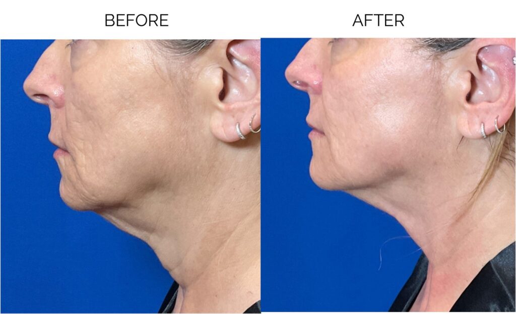 Before and after photographs of a Seranova client's jawline and neck following a combined Revatherm, Opus Plasma, and Mono RF facial program