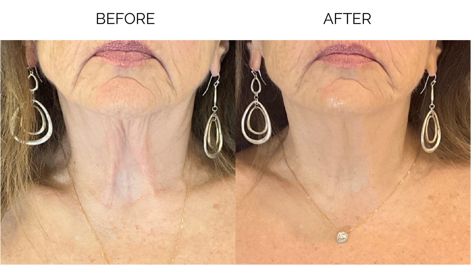 Before and after Revatherm radiofrequency neck treatment at Seranova Sculpt & Beauty in Alpharetta, near Johns Creek, GA