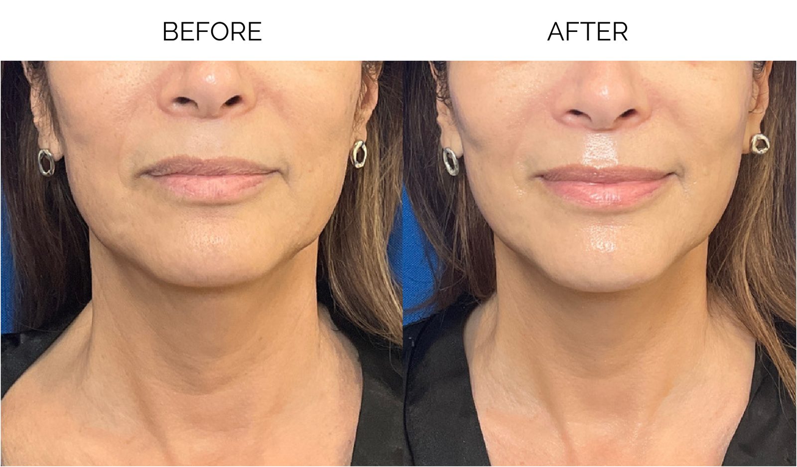Before and after a 900-pulse Revatherm face and neck treatment for a client visiting Seranova Sculpt & Beauty from the Cumming, GA area